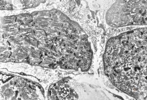 M,2m. | hypotonic syndrome - muscular atrophy